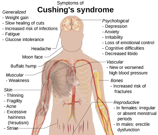 Cushing syndrome