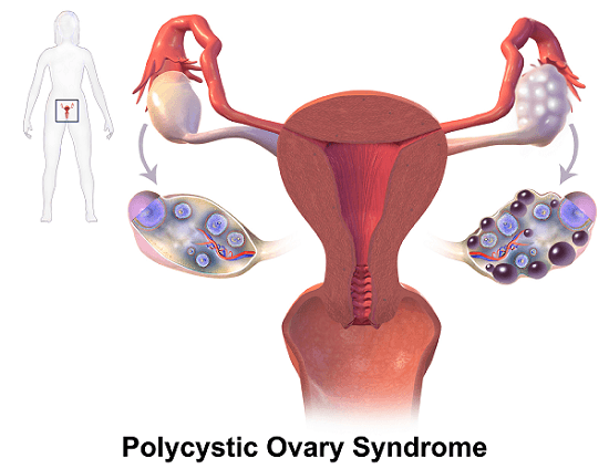 Hirsutism causes Polycystic Ovary Syndrome PCOS