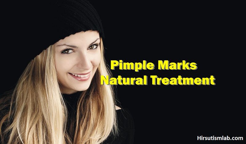 How to Remove Pimple Marks Naturally For Oily Skin